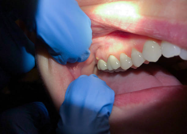 Best Emergency Tooth Extraction in Cetronia, PA
